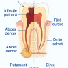 Tratamente endodontice - Clinica Dentară Dr. Jakab Botoșani